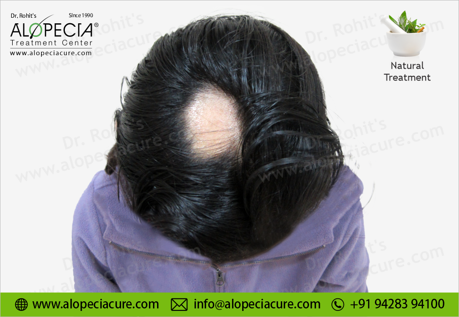 Alopecia Areata Patchy Loss